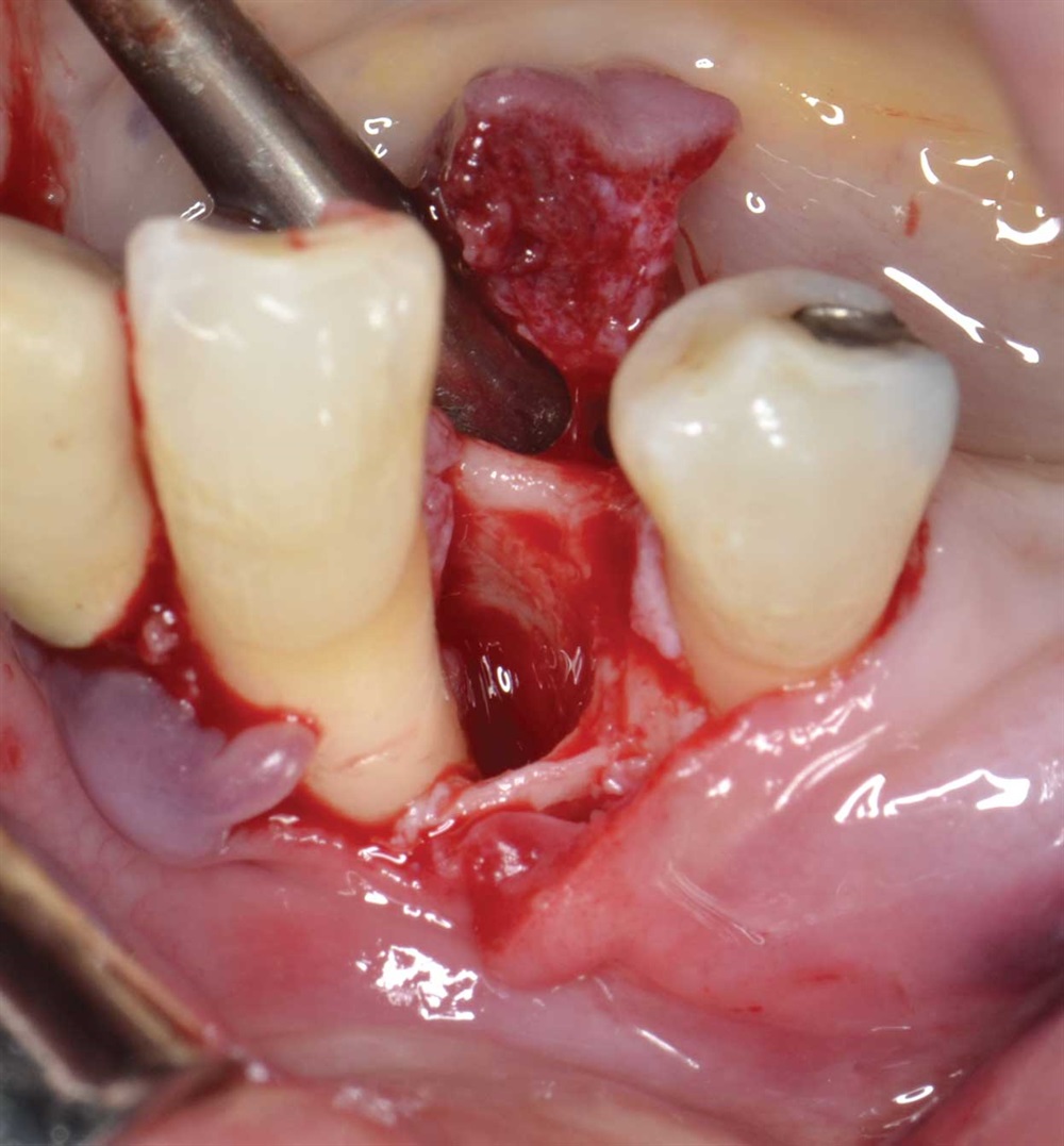 Tarquini_Periodontal intrabony defect